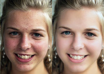 Photoshop怎么使用通道法给满脸雀斑的女人磨皮1