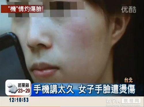 台湾少女打电话30分钟，手机发热被烫伤脸2